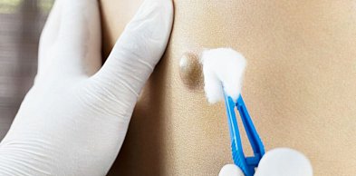 Torbiel włosowa – obraz kliniczny i zasady postępowania