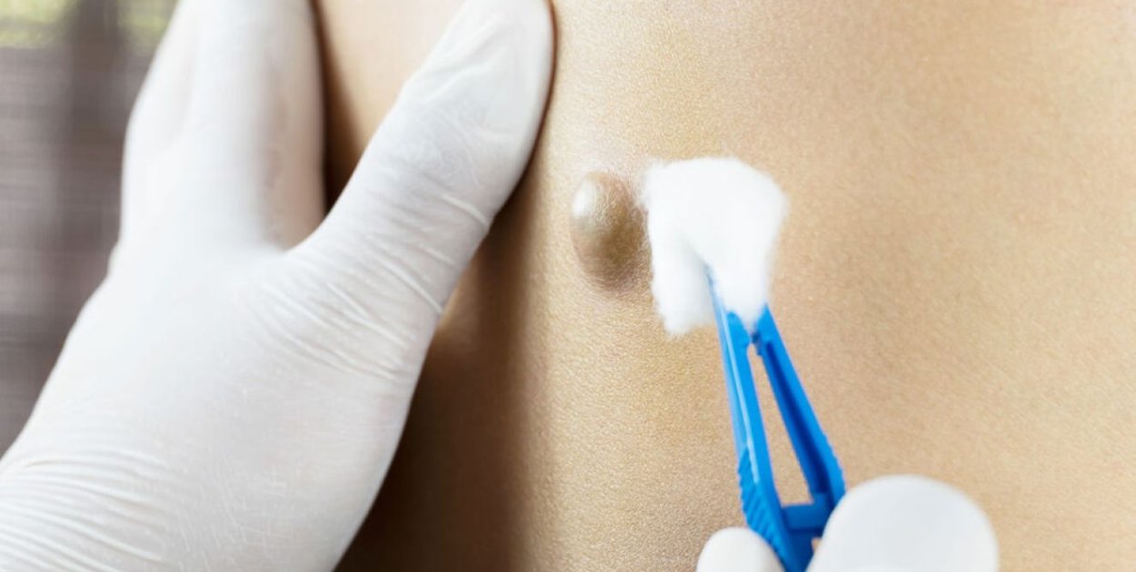 Torbiel włosowa – obraz kliniczny i zasady postępowania